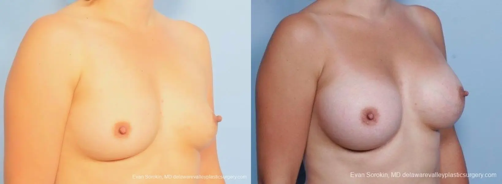 Philadelphia Breast Augmentation 8797 - Before and After 2