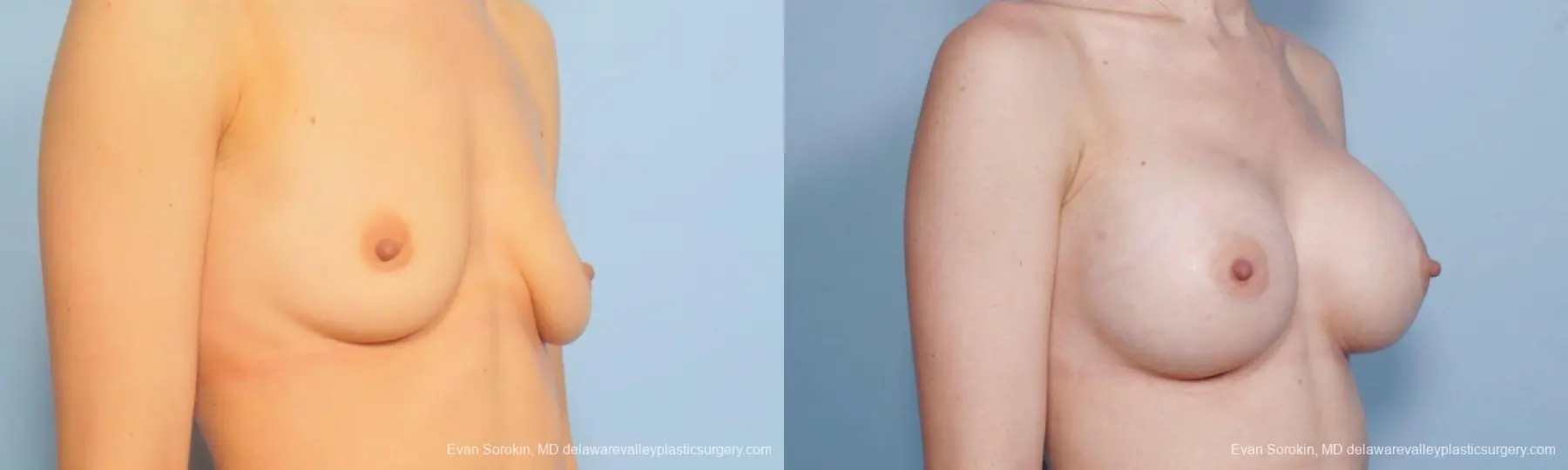 Philadelphia Breast Augmentation 9170 - Before and After 2