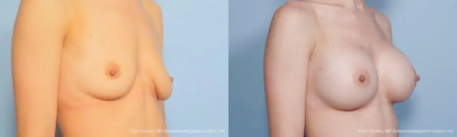 Philadelphia Breast Augmentation 9170 - Before and After 2