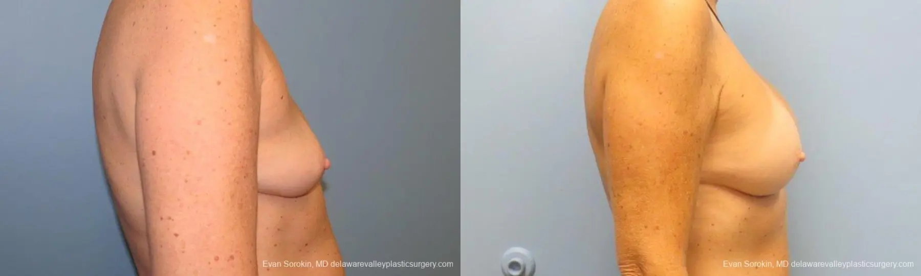 Philadelphia Breast Augmentation 9549 - Before and After 3