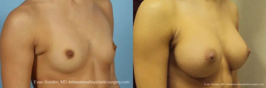 Philadelphia Breast Augmentation 9408 - Before and After 2