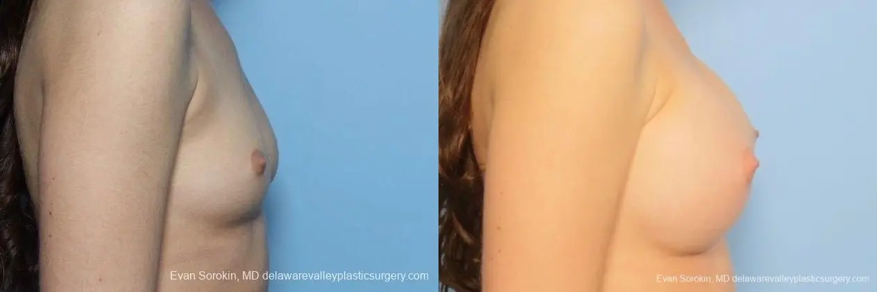 Philadelphia Breast Augmentation 8771 - Before and After 4