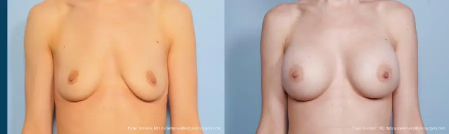 Philadelphia Breast Augmentation 9170 - Before and After 1