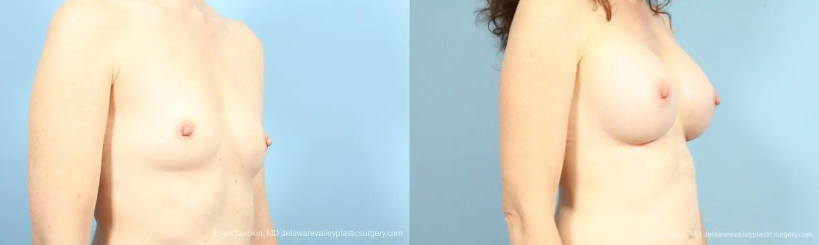 Philadelphia Breast Augmentation 8662 - Before and After 2