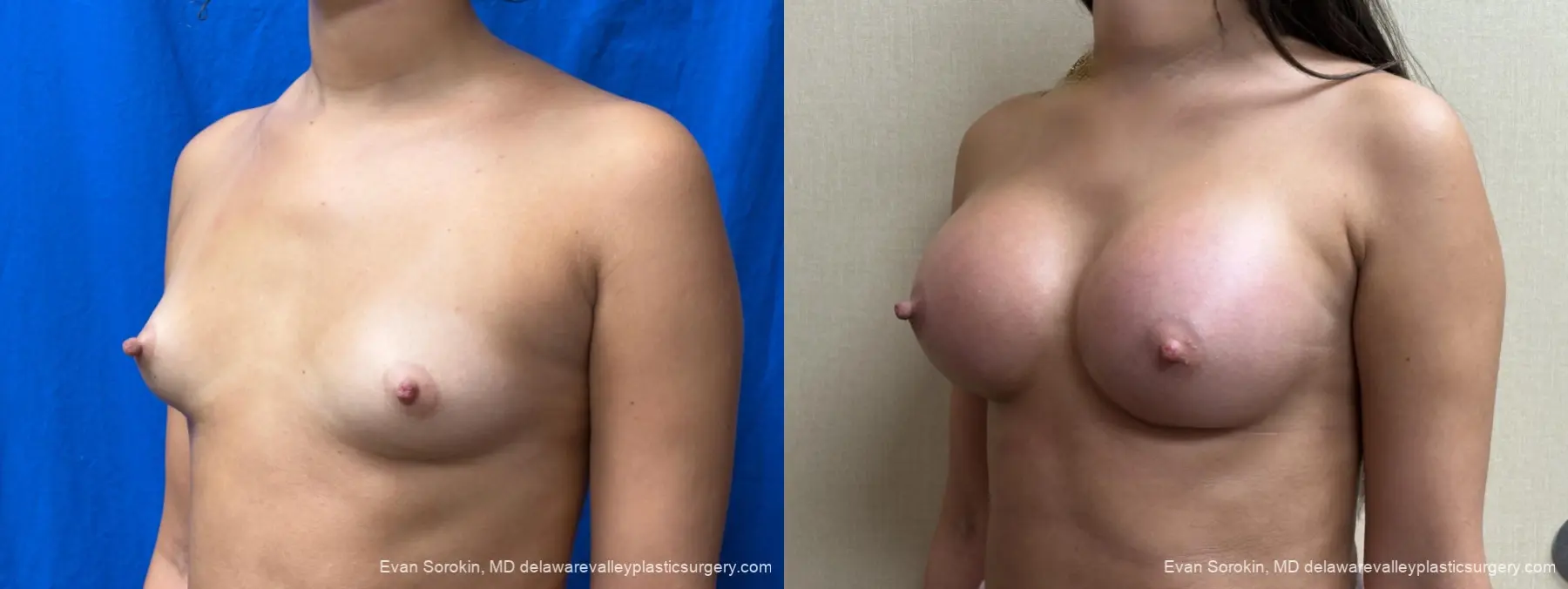 Breast Augmentation: Patient 283 - Before and After 4