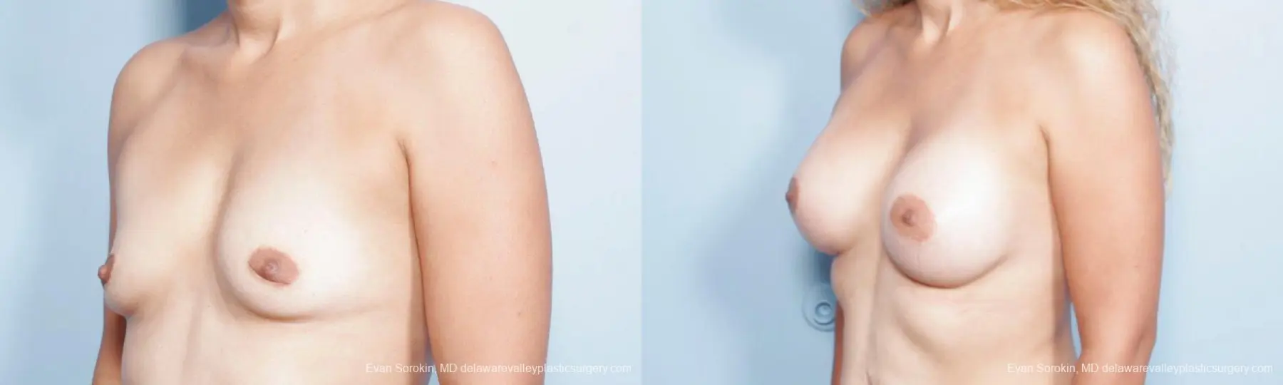 Philadelphia Breast Augmentation 9347 - Before and After 4
