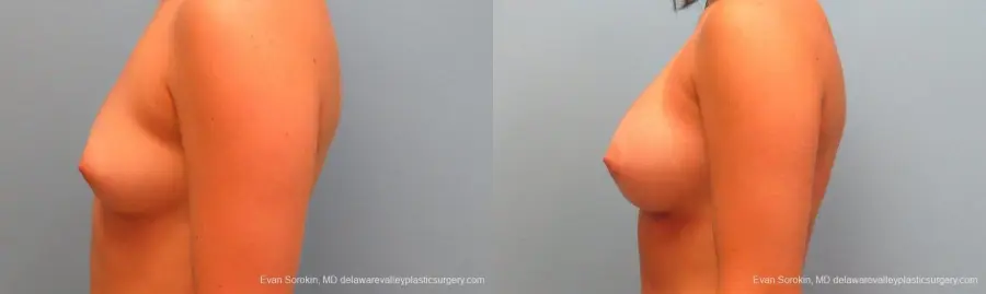 Philadelphia Breast Augmentation 9386 - Before and After 5