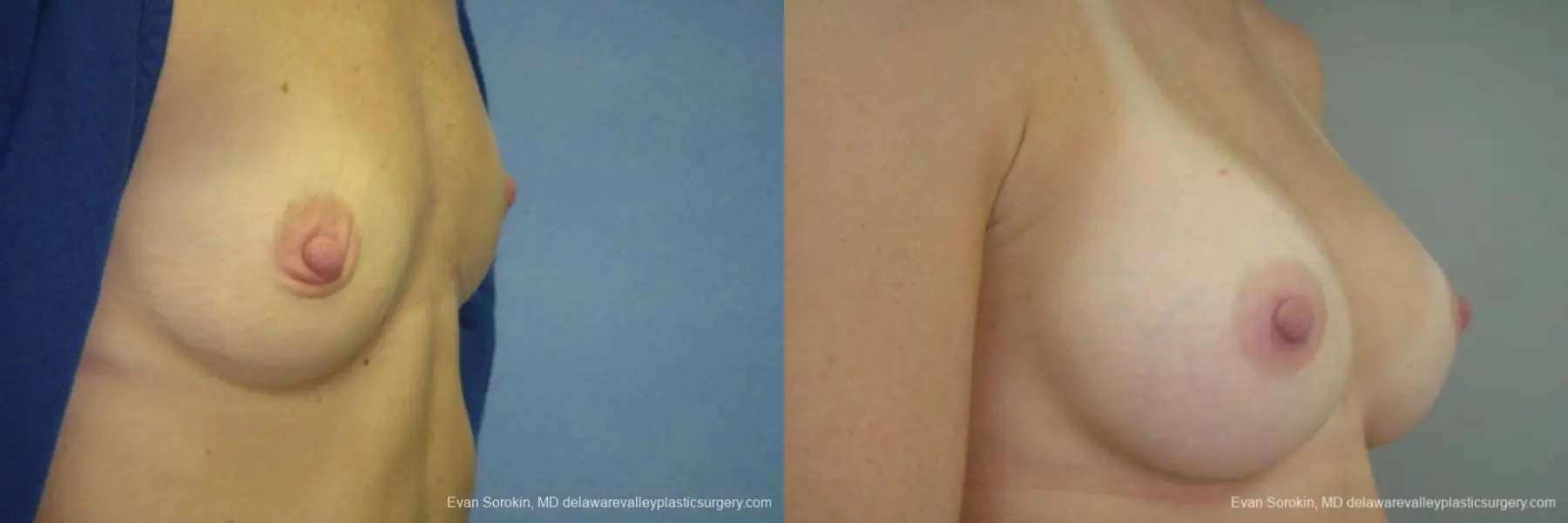 Philadelphia Breast Augmentation 9403 - Before and After 2