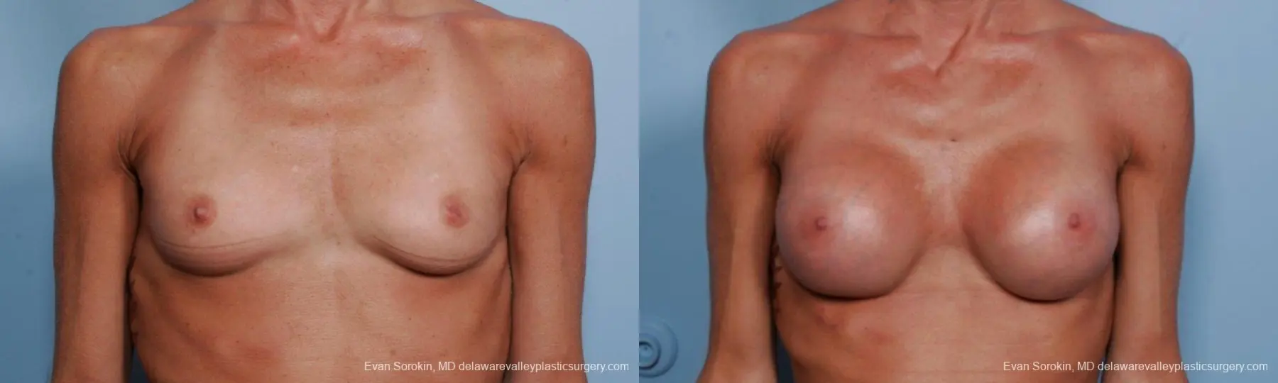 Philadelphia Breast Augmentation 8656 - Before and After 1