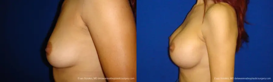Philadelphia Breast Augmentation 9294 - Before and After 3