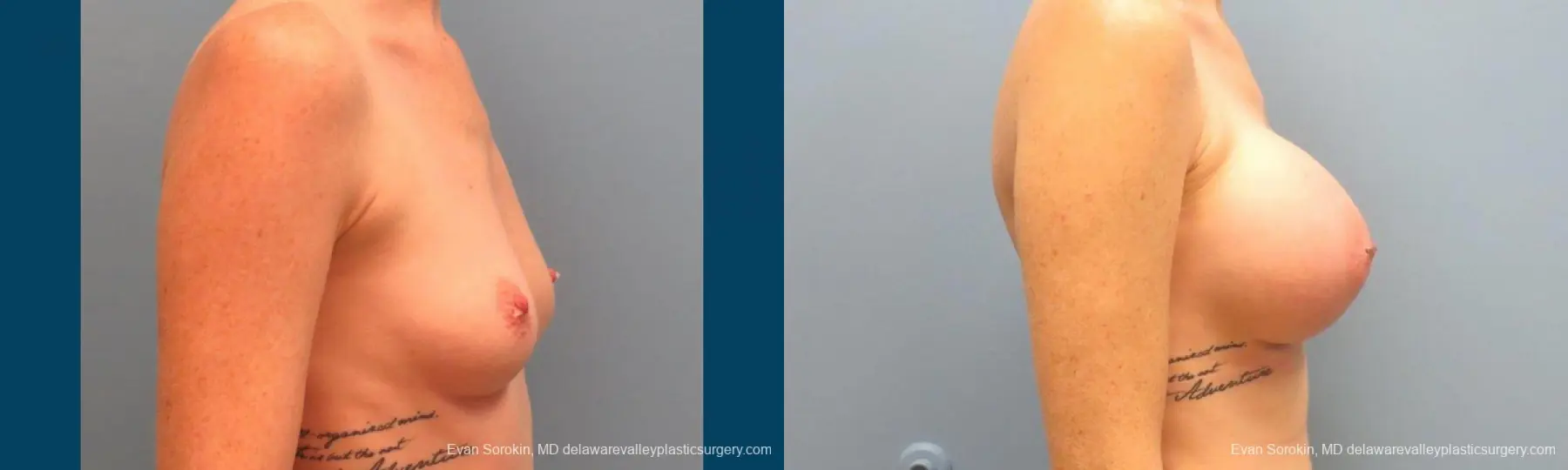 Philadelphia Breast Augmentation 9371 - Before and After 3