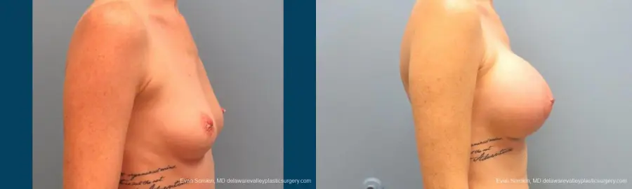Philadelphia Breast Augmentation 9371 - Before and After 3