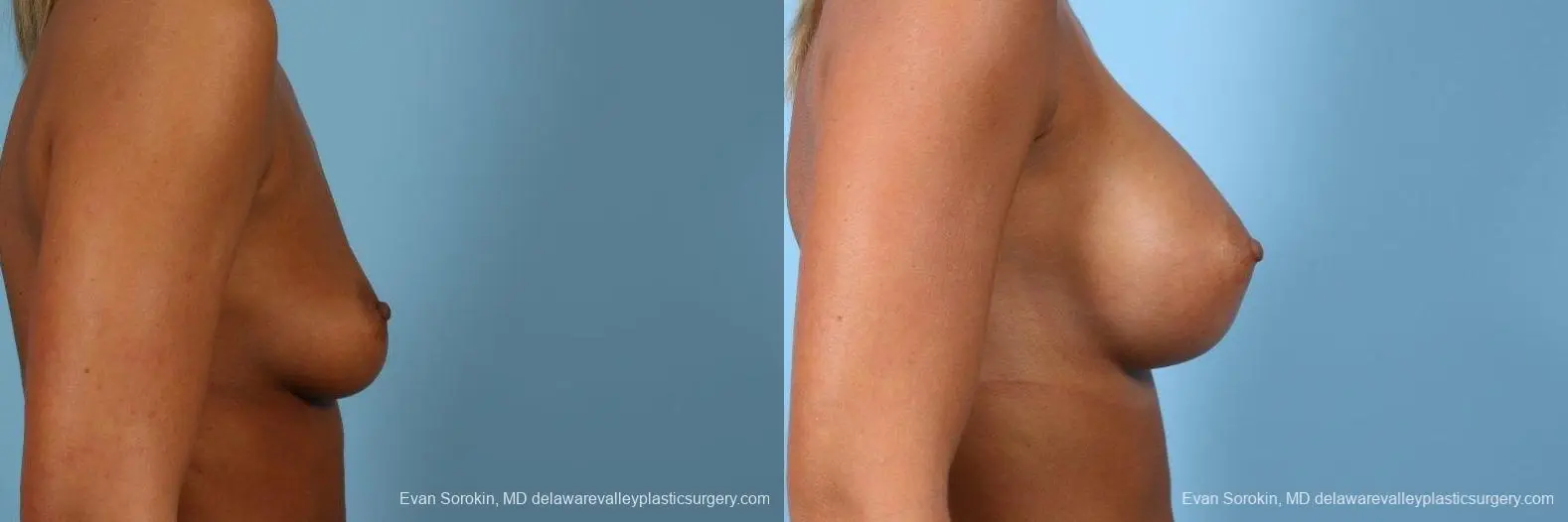 Philadelphia Breast Augmentation 9404 - Before and After 3