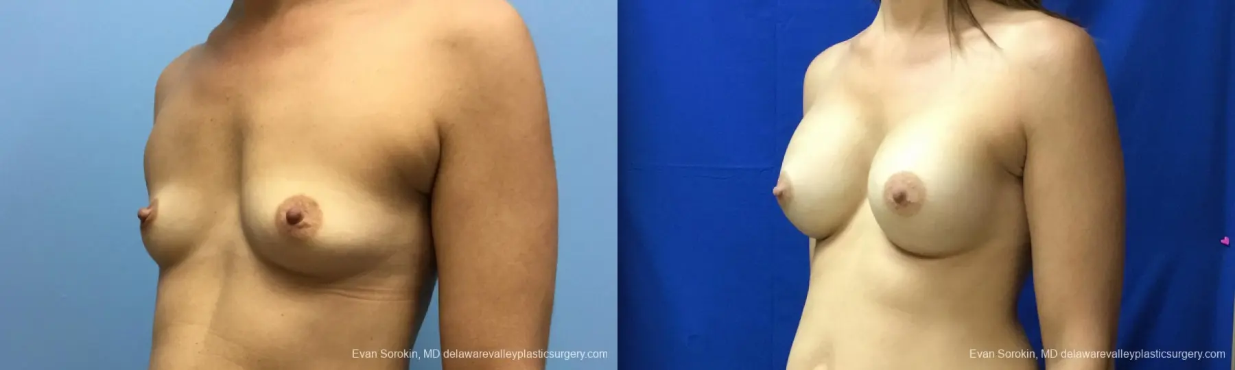 Philadelphia Breast Augmentation 12519 - Before and After 3