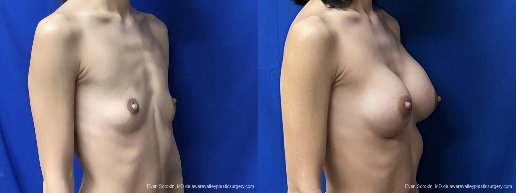 Breast Augmentation: Patient 206 - Before and After 2