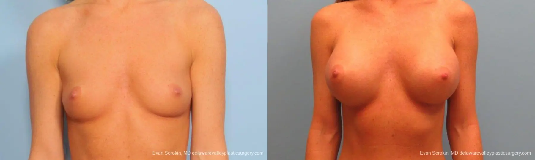 Philadelphia Breast Augmentation 9179 - Before and After 1