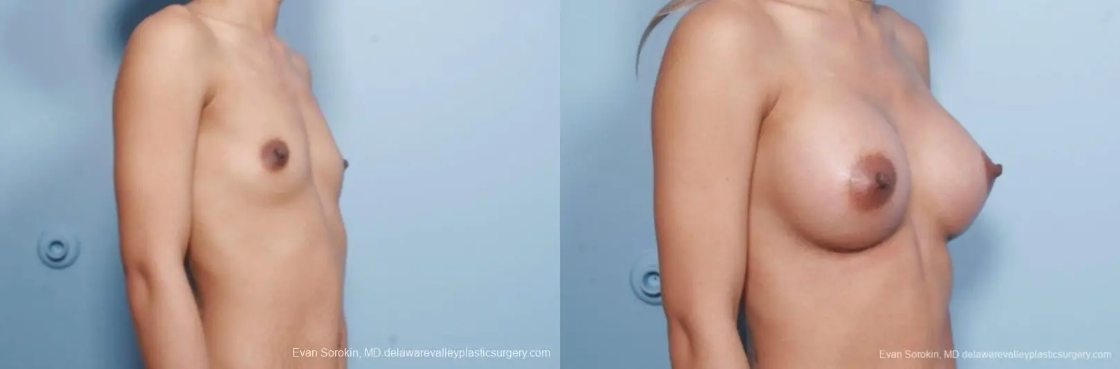 Philadelphia Breast Augmentation 9106 - Before and After 2