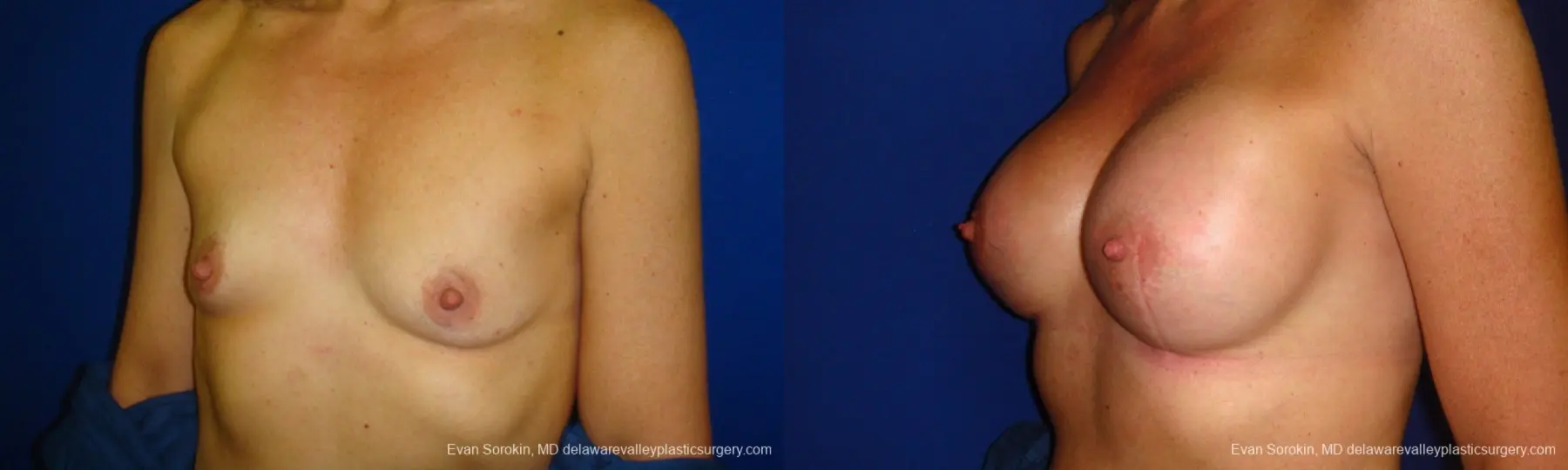 Philadelphia Breast Augmentation 9412 - Before and After 4