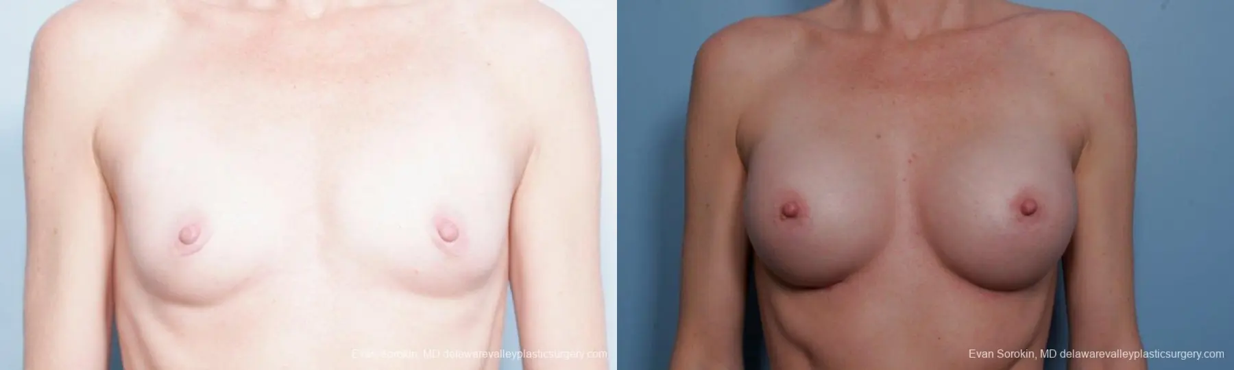 Philadelphia Breast Augmentation 9359 - Before and After