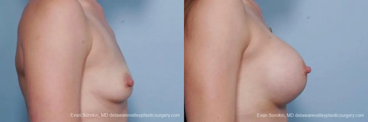 Philadelphia Breast Augmentation 8767 - Before and After 4