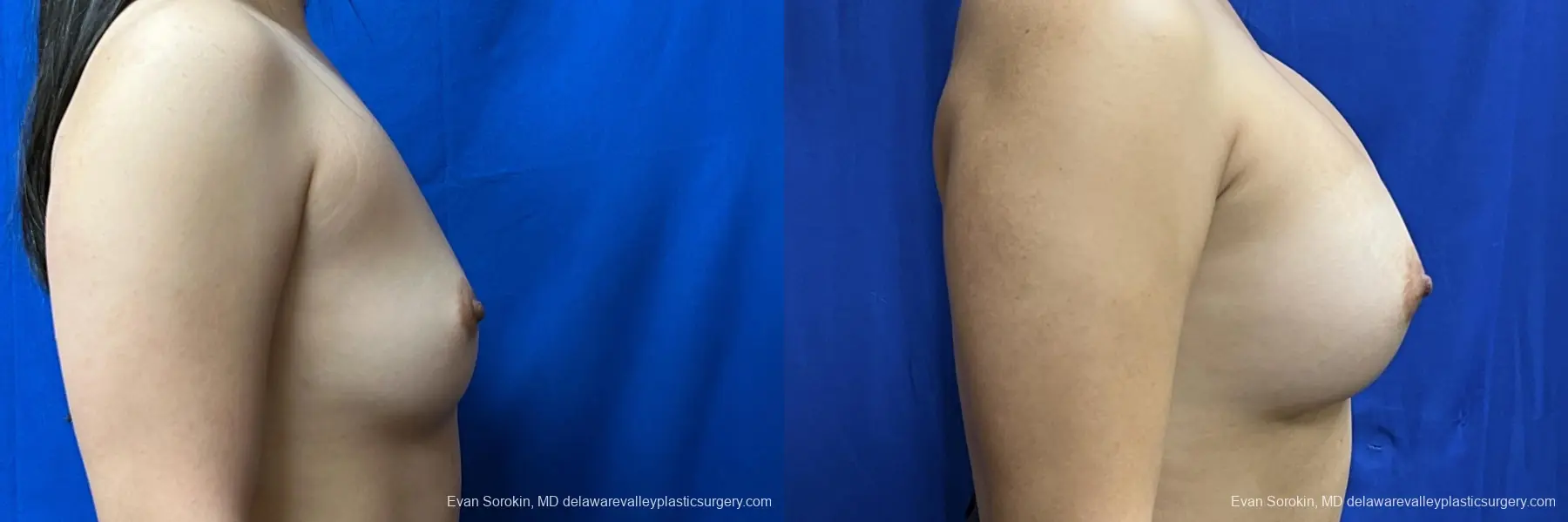Breast Augmentation: Patient 210 - Before and After 3