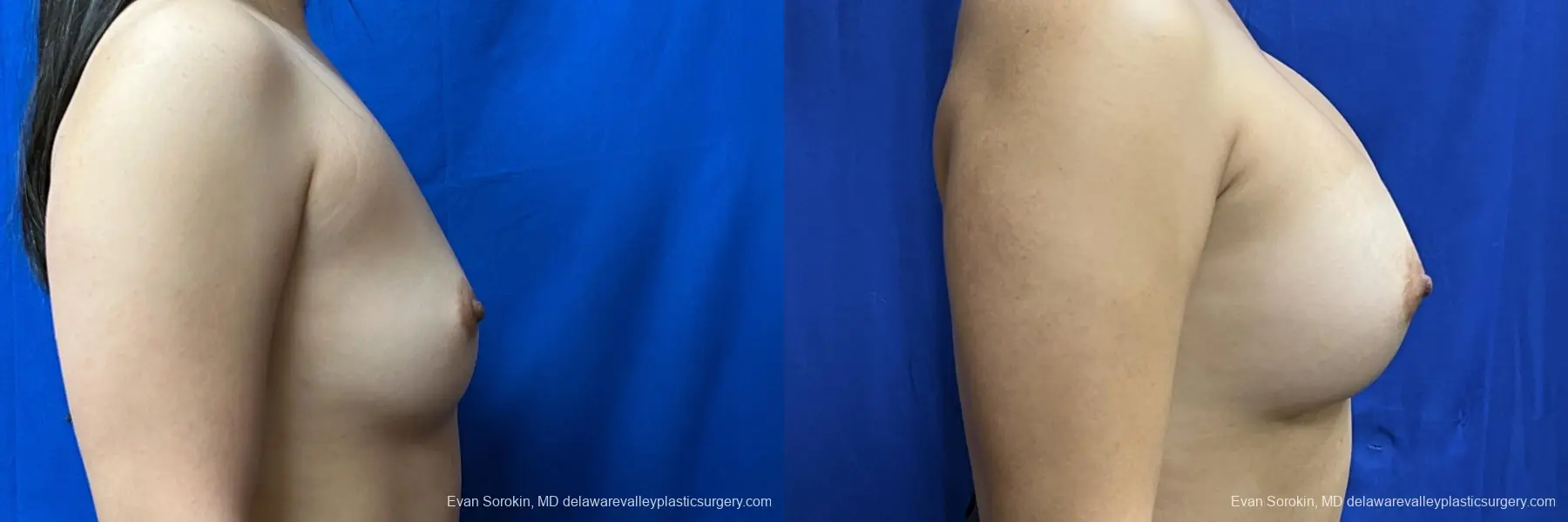 Breast Augmentation: Patient 212 - Before and After 3