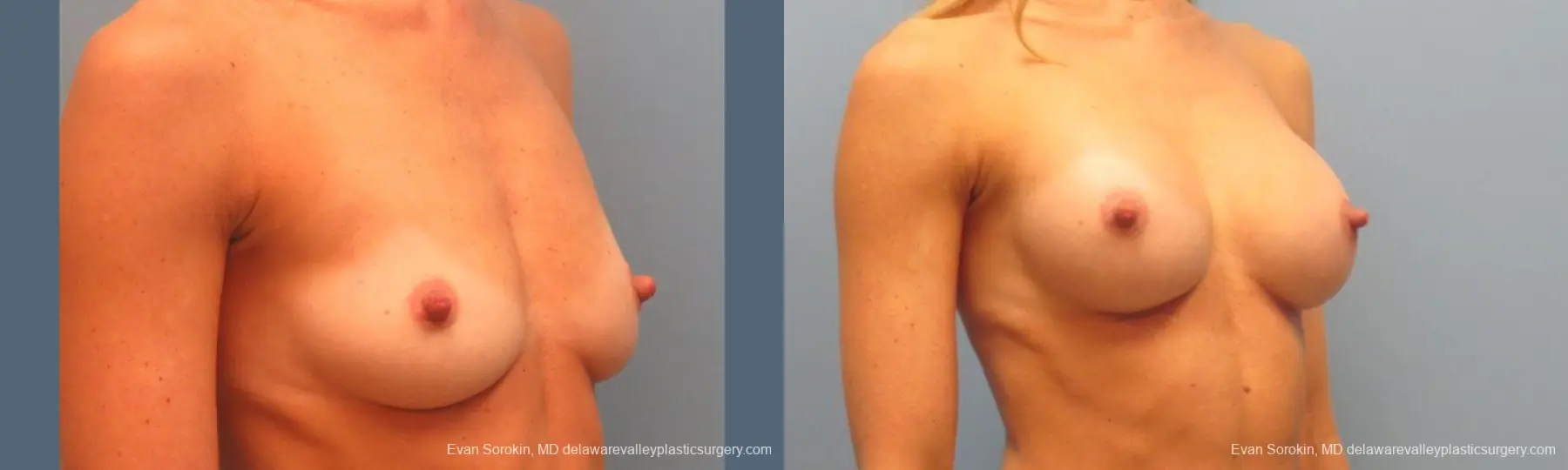 Philadelphia Breast Augmentation 9396 - Before and After 2