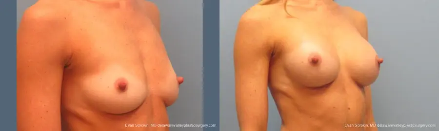 Philadelphia Breast Augmentation 9396 - Before and After 2