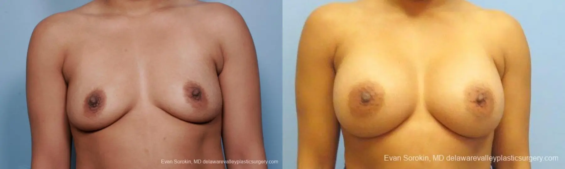 Philadelphia Breast Augmentation 9387 - Before and After 1