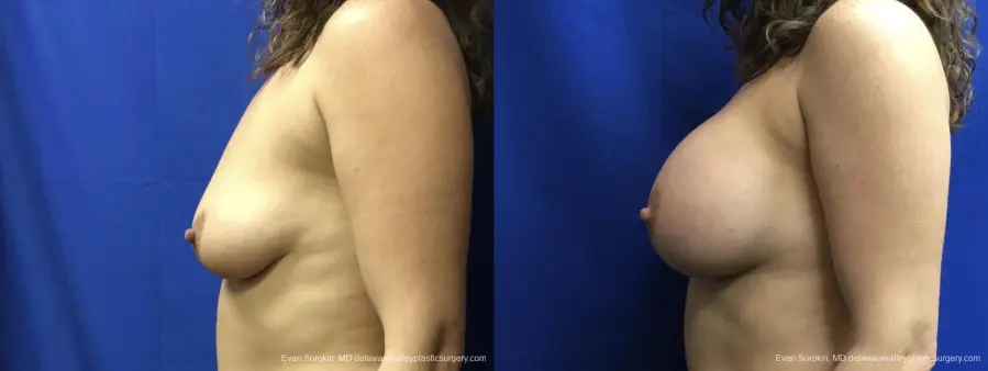 Breast Augmentation: Patient 241 - Before and After 5