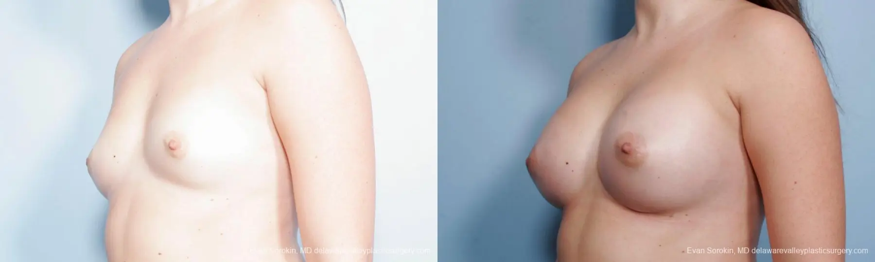 Philadelphia Breast Augmentation 9357 - Before and After 4