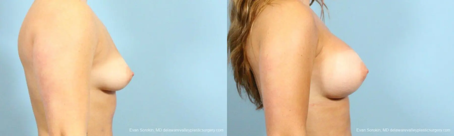 Philadelphia Breast Augmentation 8650 - Before and After 4
