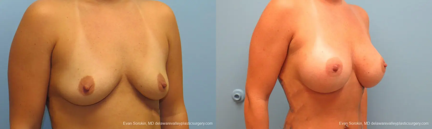 Philadelphia Breast Augmentation 9388 - Before and After 2