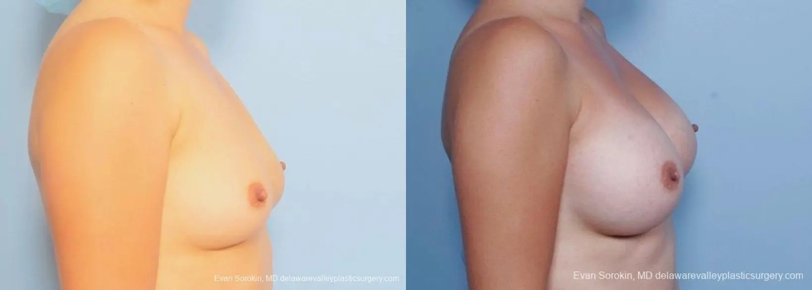 Philadelphia Breast Augmentation 8797 - Before and After 4