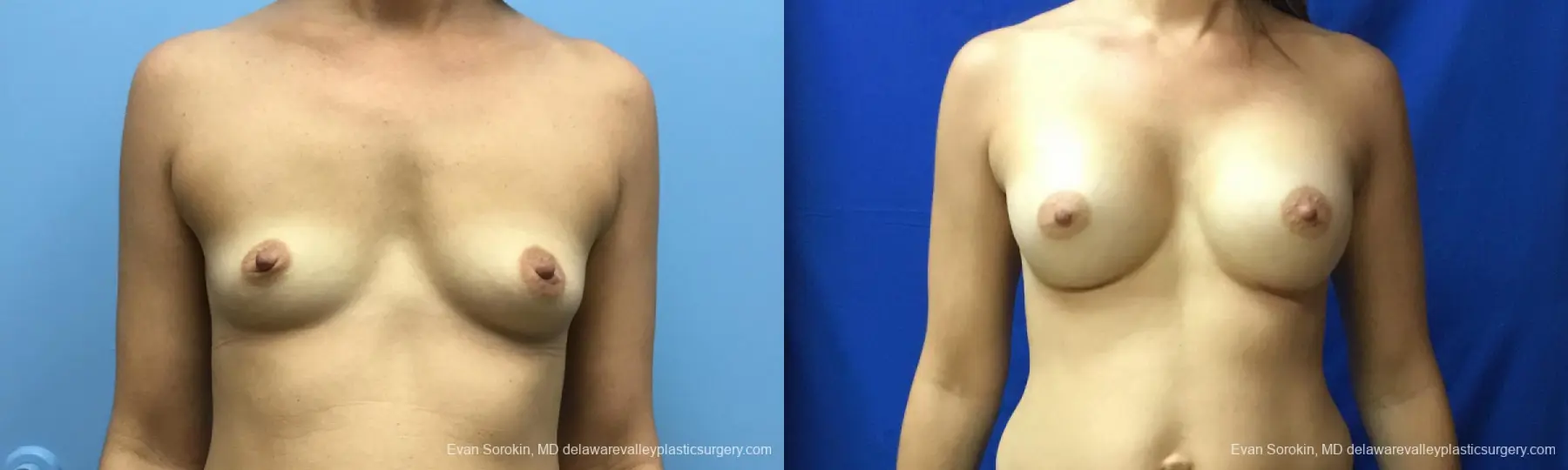 Philadelphia Breast Augmentation 12519 - Before and After 1