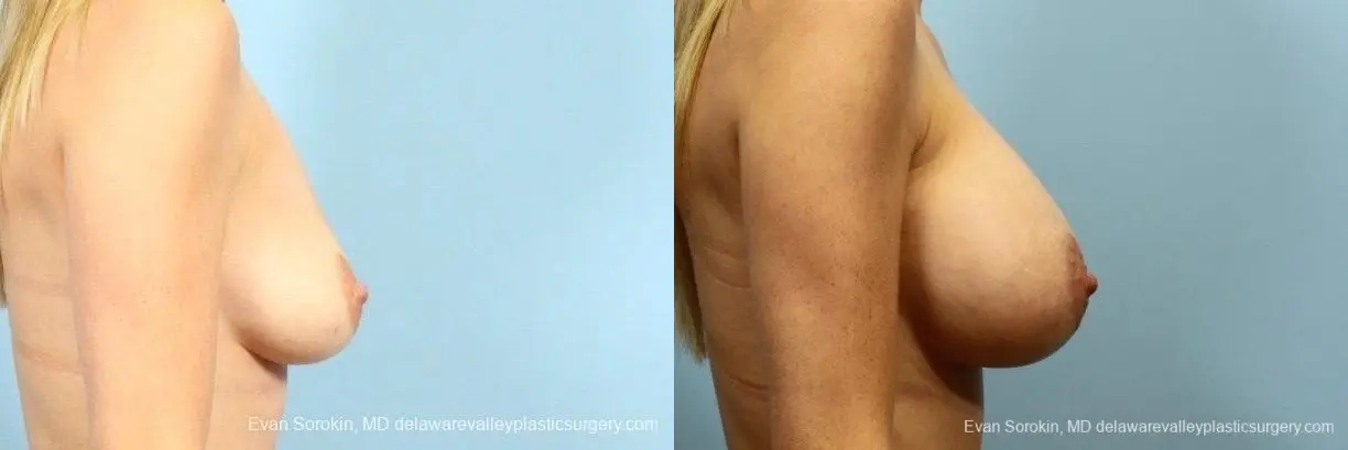 Philadelphia Breast Augmentation 8782 - Before and After 4