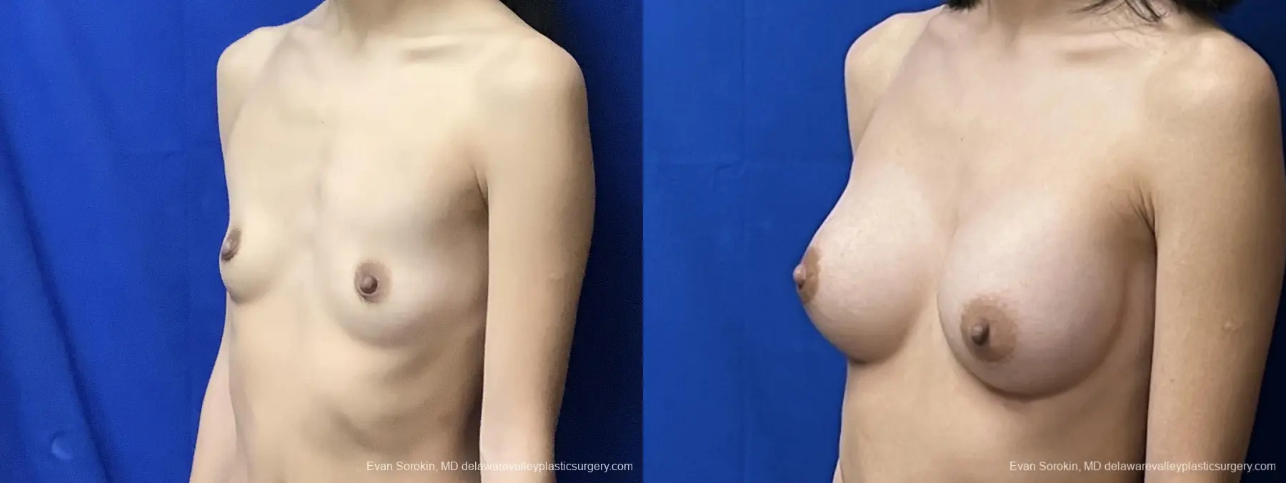 Breast Augmentation: Patient 208 - Before and After 4