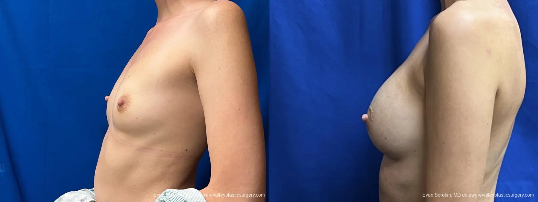 Breast Augmentation: Patient 242 - Before and After 5