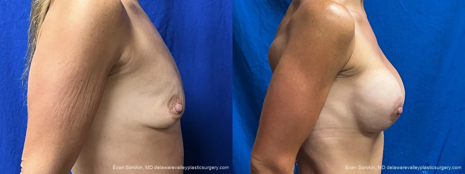 Breast Augmentation: Patient 305 - Before and After 3