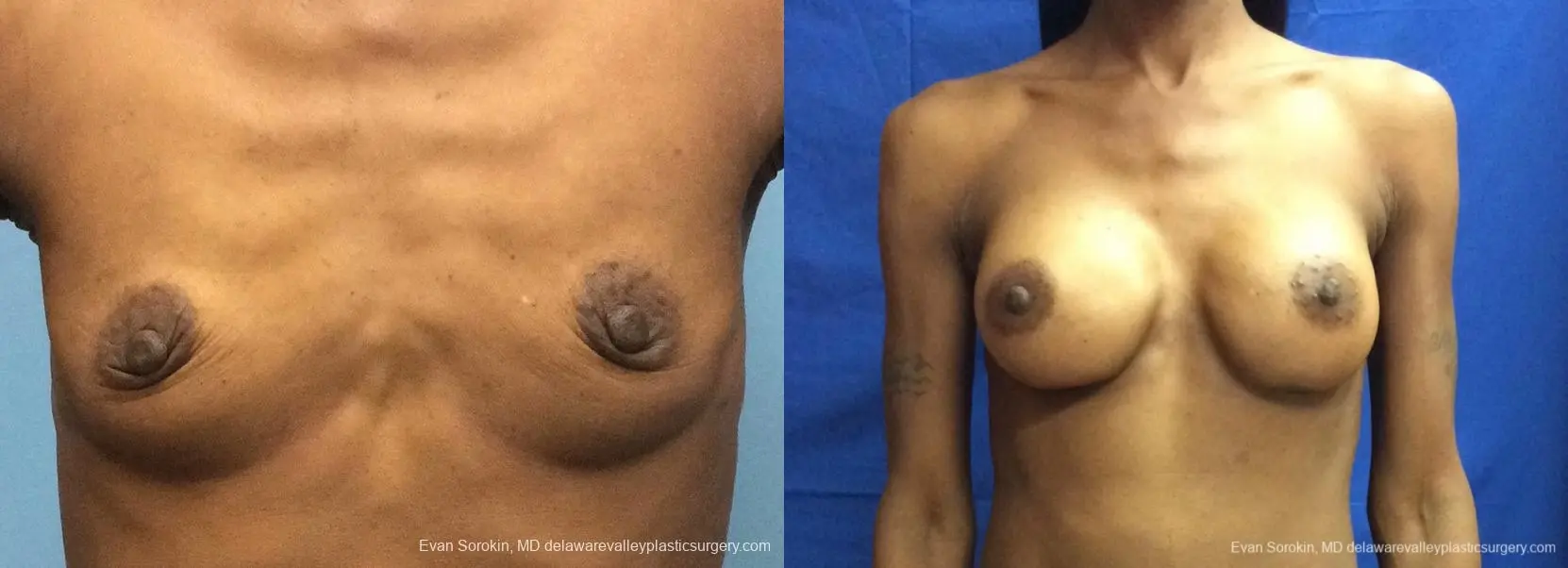 Philadelphia Breast Augmentation 13072 - Before and After 1