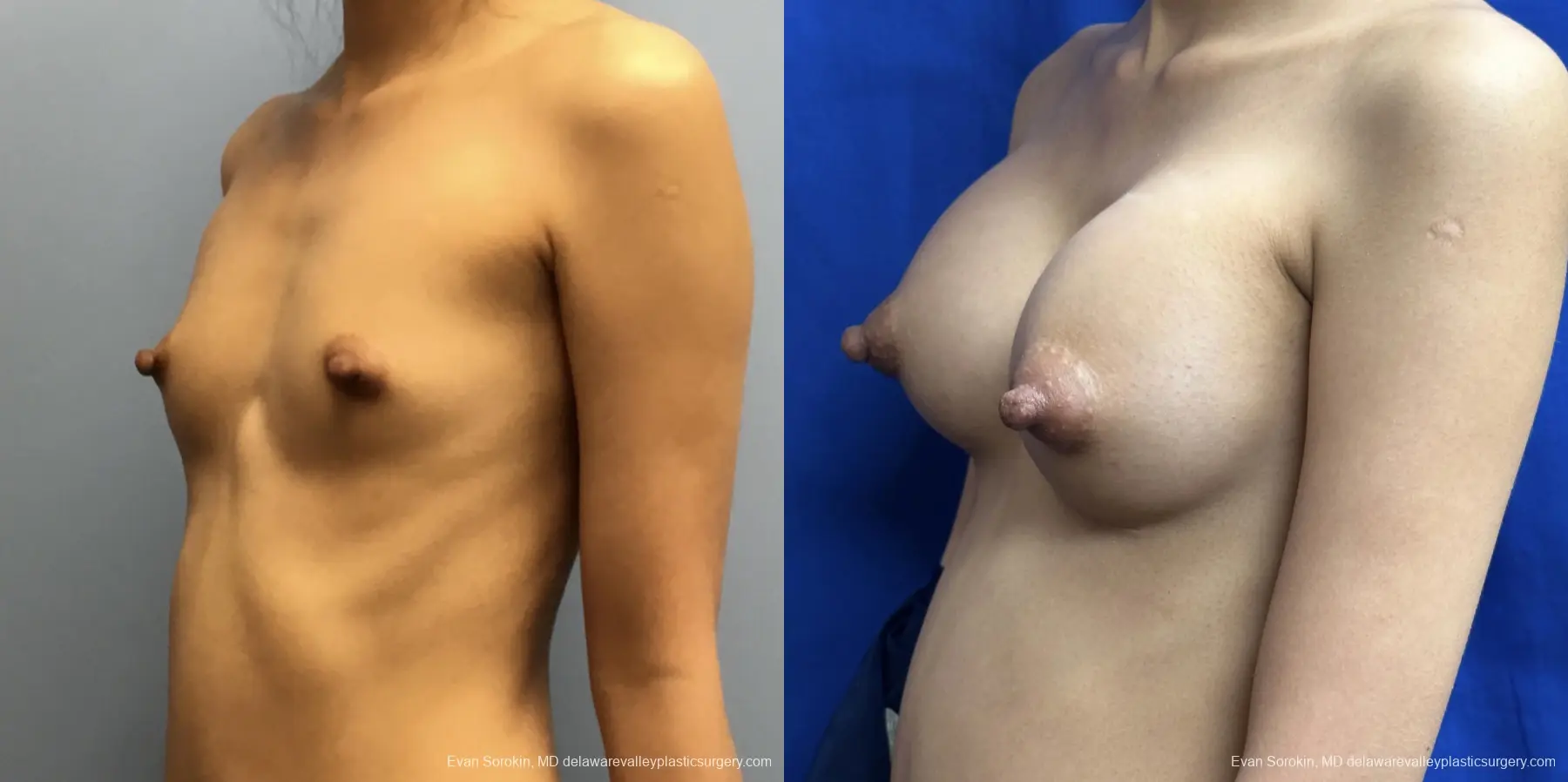 Breast Augmentation: Patient 211 - Before and After 4