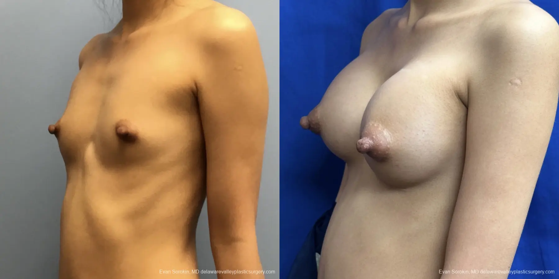 Breast Augmentation: Patient 251 - Before and After 4