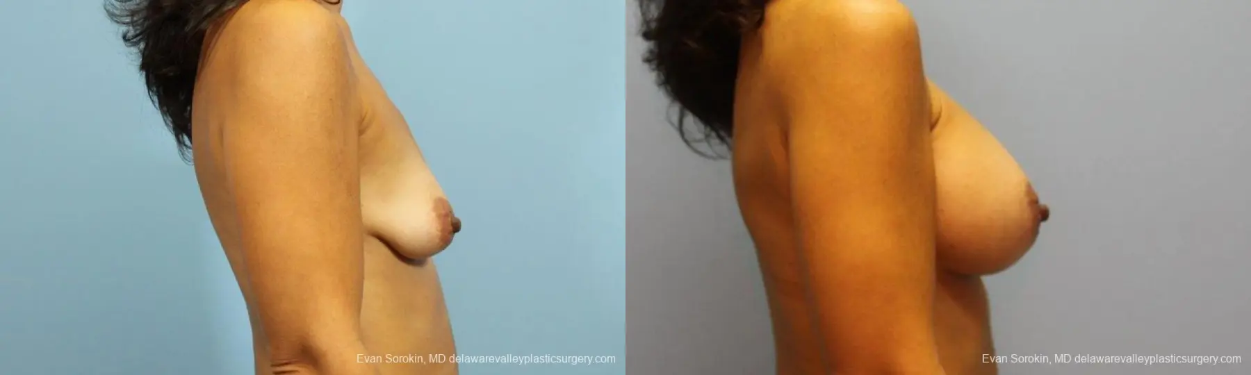 Philadelphia Breast Augmentation 9422 - Before and After 3