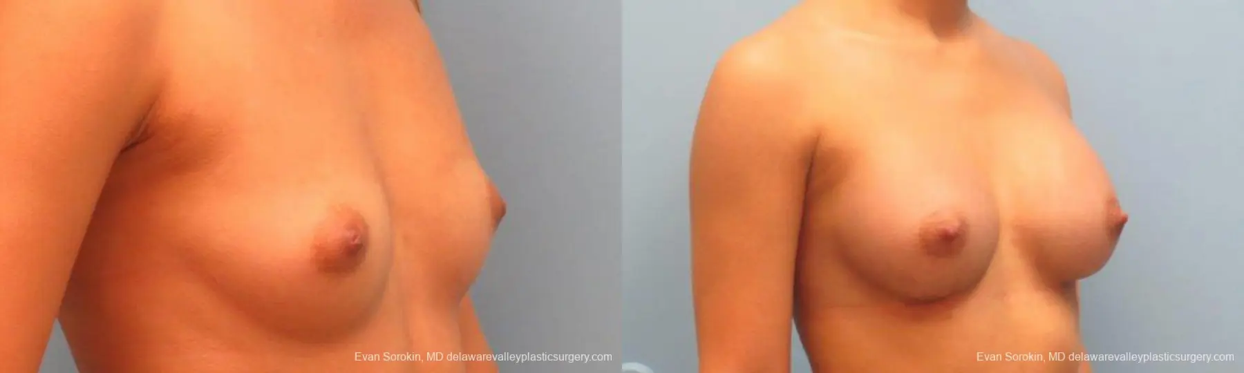 Philadelphia Breast Augmentation 9341 - Before and After 2