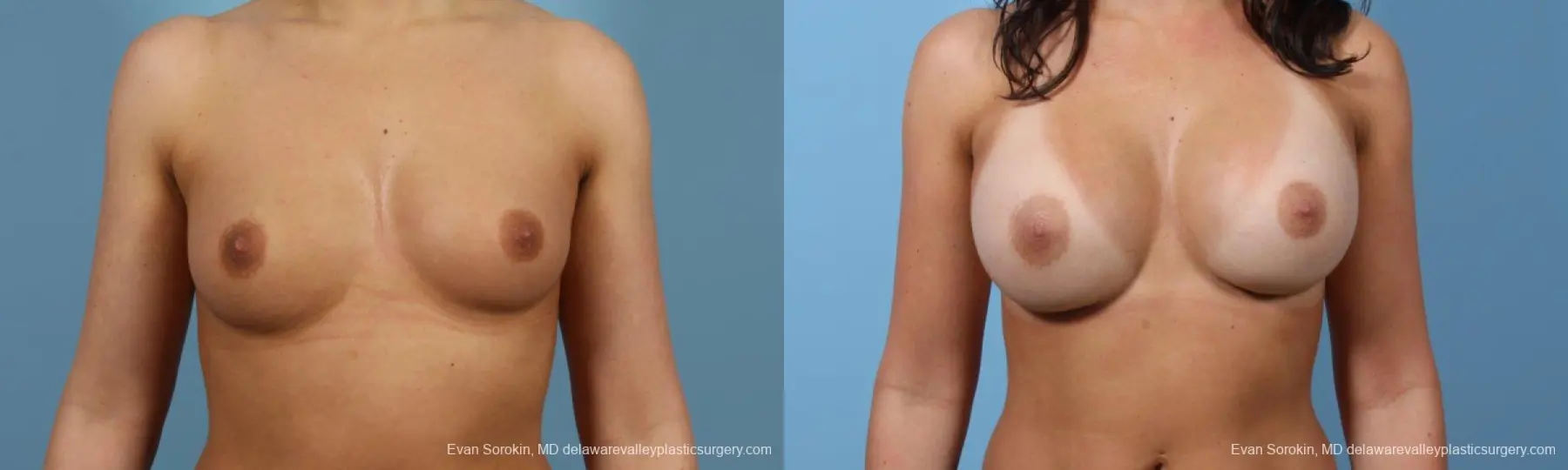 Philadelphia Breast Augmentation 8643 - Before and After 1