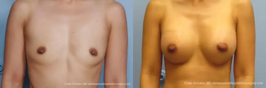 Philadelphia Breast Augmentation 8661 - Before and After 1