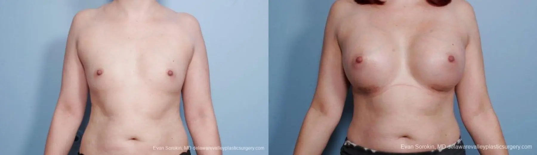 Breast Augmentation: Patient 55 - Before and After 1