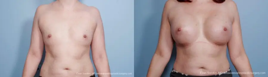 Breast Augmentation: Patient 54 - Before and After 1