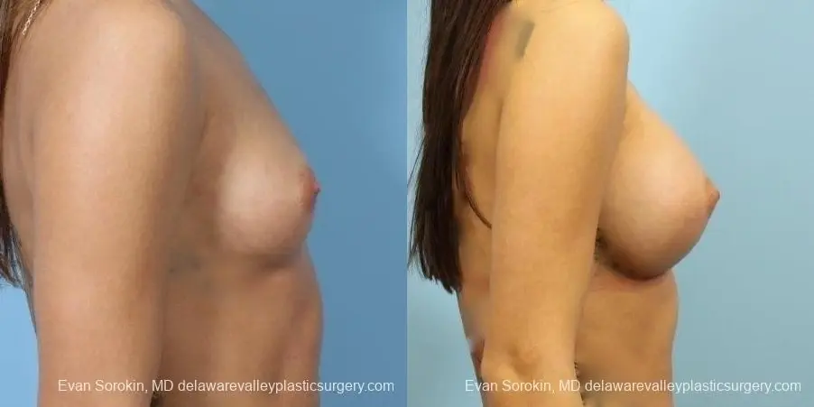 Philadelphia Breast Augmentation 8657 - Before and After 4