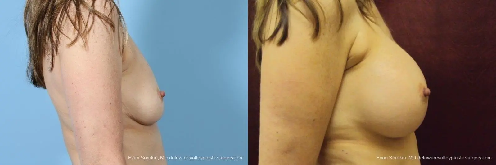 Philadelphia Breast Augmentation 8708 - Before and After 5